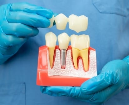 schéma d'une couronne dentiare