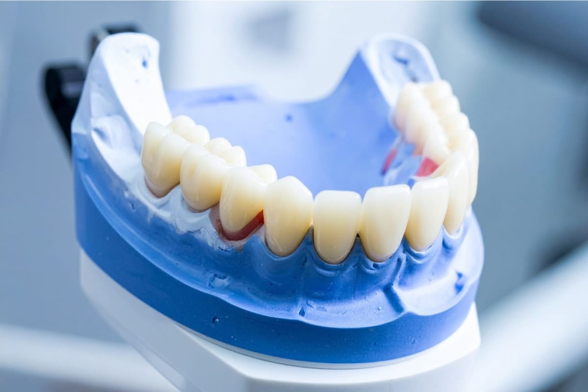 Vue d'une prothèse dentaire amovible à La Réunion