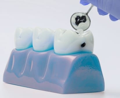 image d'une carie à la loupe