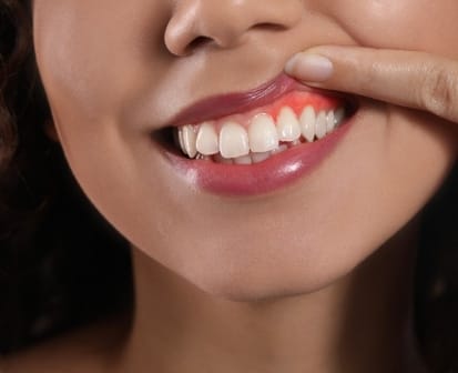 Femme souriante, gencives rouges, parodontie